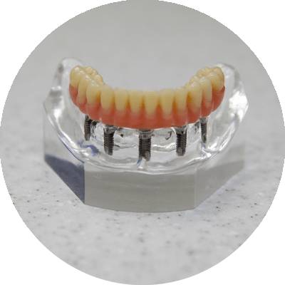 full arch implant model on counter